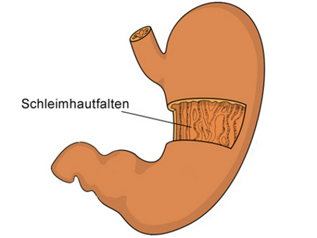 Gastritis ist eine entzündliche und schmerzhafte Erkrankung der Magenschleimhaut. Magenschleimhaut