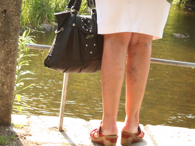 Venenuntersuchung bei Krampfadern Venenuntersuchung