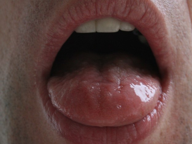 Rückschlüsse auf Krankheiten und ihre Ursachen. Zunge