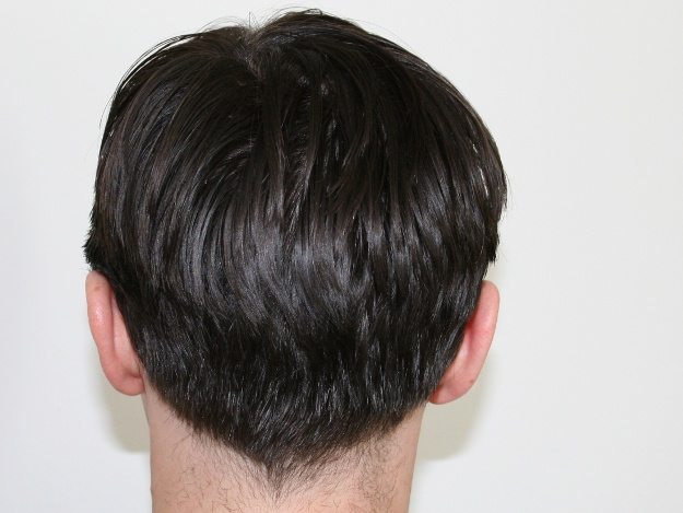 Was sind die Gründe für Kopfschuppen und was kann dagegen getan werden? Haare